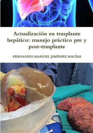 Actualizacion En Trasplante Hepatico de Fernando Manuel Jimenez Macias