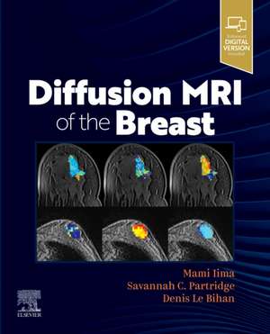 Diffusion MRI of the Breast (RMN/