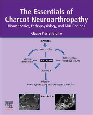 The Essentials of Charcot Neuroarthropathy: Biomechanics, Pathophysiology, and MRI Findings de Claude Pierre-Jerome