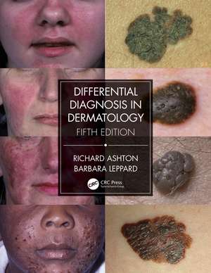 Differential Diagnosis in Dermatology de Richard Ashton