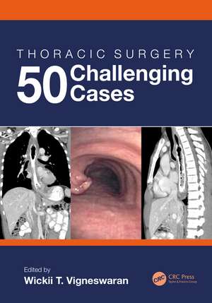 Thoracic Surgery: 50 Challenging cases de Wickii Vigneswaran