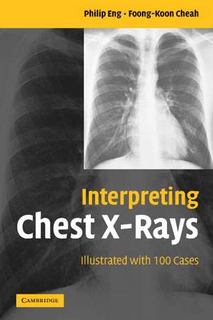 Interpreting Chest X-Rays: Illustrated with 100 Cases de Philip Eng