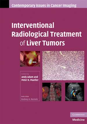 Interventional Radiological Treatment of Liver Tumors de Andy Adam