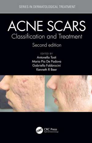 Acne Scars: Classification and Treatment, Second Edition de Antonell Tosti