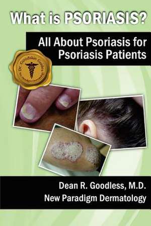 What Is Psoriasis? de Dean R. Goodless MD