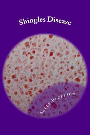 Shingles Disease de Sally Pederson