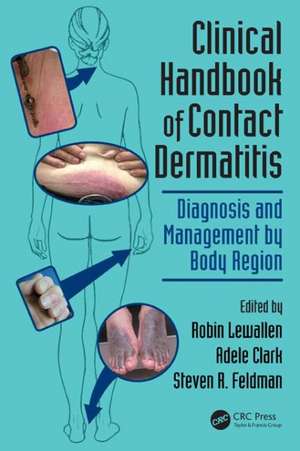 Clinical Handbook of Contact Dermatitis: Diagnosis and Management by Body Region de Robin Lewallen