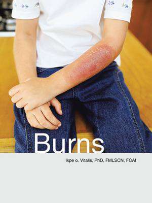 Burns de Phd Fmlscn Fcai Vitalis