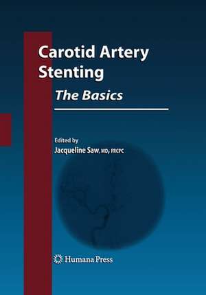 Carotid Artery Stenting: The Basics de Jacqueline Saw