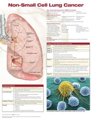 Non-Small Cell Lung Cancer de Anatomical Chart Company