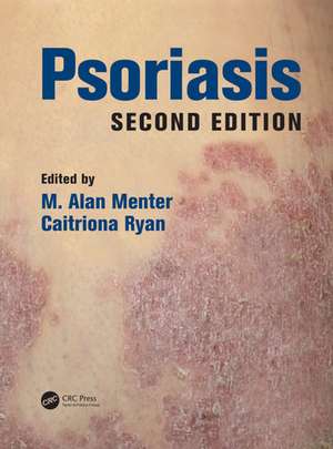 Psoriasis de M. Alan Menter