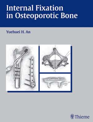 Internal Fixation in Osteoporotic Bone de Yuehuei H. An