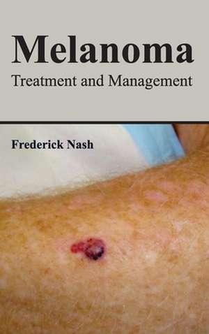 Melanoma de Frederick Nash