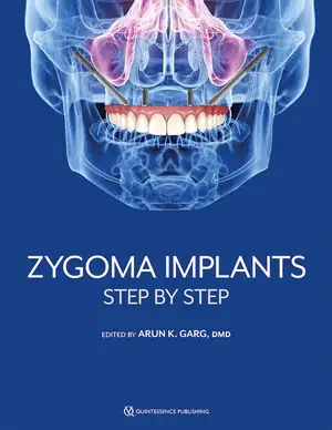 Zygoma Implants: Step by Step de Arun K. Garg