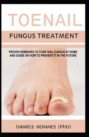 Toenail Fungus Treatment: Proven Remedies to Cure Nail Fungus at Home and Guide on How to Prevent It in the Future de Daniels Hommes (Phd)