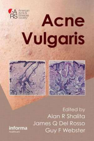 Acne Vulgaris de Alan R. Shalita