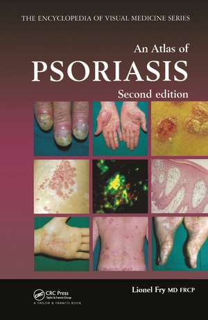 An Atlas of Psoriasis, Second Edition de Lionel Fry