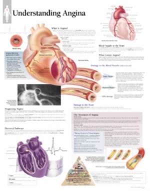 Understanding Angina Chart: Wall Chart de Scientific Publishing