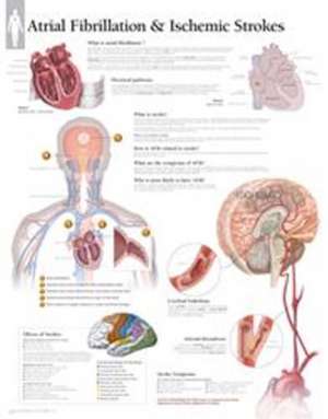 Atrial Fib & Ischemic Strokes Paper Poster de Scientific Publishing