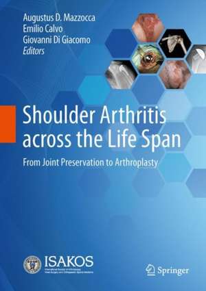 Shoulder Arthritis across the Life Span: From Joint Preservation to Arthroplasty de Augustus D. Mazzocca