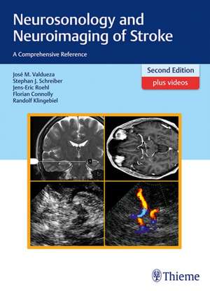 Neurosonology and Neuroimaging of Stroke – A Comprehensive Reference de José Manuel Valdueza