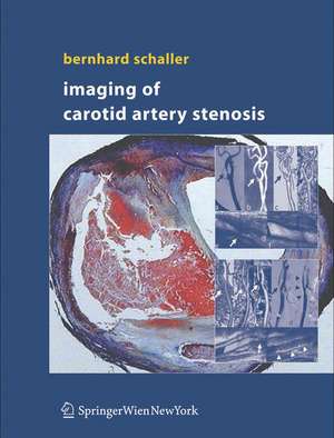 Imaging of Carotid Artery Stenosis de Bernhard Schaller