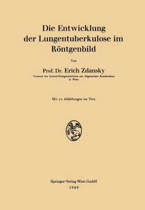 Die Entwicklung der Lungentuberkulose im Röntgenbild de Erich Zdansky