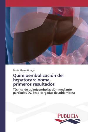 Quimioembolizacion del Hepatocarcinoma, Primeros Resultados: Historia y Aplicaciones Actuales de Maria Muros Ortega