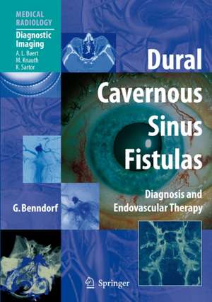 Dural Cavernous Sinus Fistulas: Diagnosis and Endovascular Therapy de Goetz Benndorf