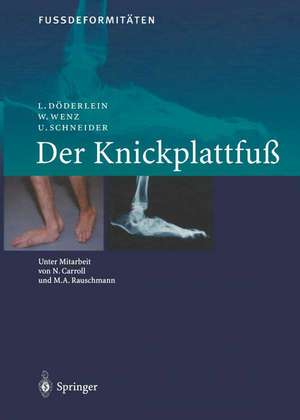 FussdeformitÄten: Der Knickplattfuss de N. Caroll