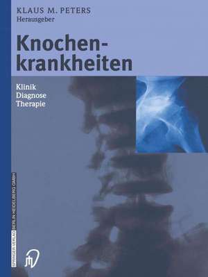 Knochenkrankheiten: Klinik Diagnose Therapie de Klaus M. Peters