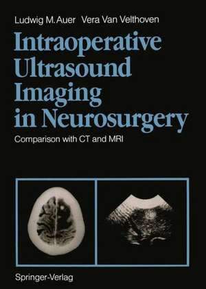 Intraoperative Ultrasound Imaging in Neurosurgery: Comparison with CT and MRI de Ludwig M. Auer