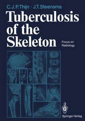 Tuberculosis of the Skeleton: Focus on Radiology de Cornelis J. P. Thijn