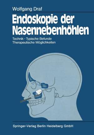 Endoskopie der Nasennebenhöhlen: Technik · Typische Befunde, Therapeutische Möglichkeiten de Wolfgang Draf