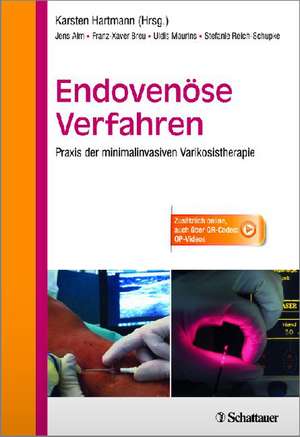 Endovenöse Verfahren de Jens Alm