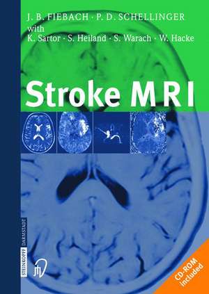 Stroke MRI de Jochen Fiebach