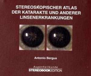 Stereoskopischer Atlas der Katarakte und anderer Linsenerkrankungen de Antonio Bergua