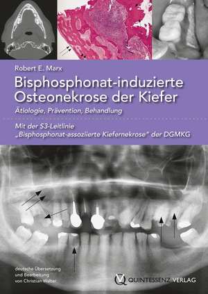 Bisphosphonat-induzierte Osteonekrose der Kiefer de Robert E. Marx