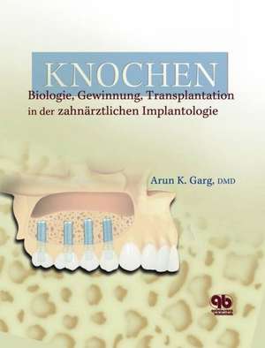 Knochen: Biologie, Gewinnung, Transplantation in der zahnärztlichen Implantologie de Arun K. Garg