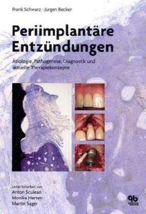 Periimplantäre Entzündungen: Ätiologie, Pathogenese, Diagnostik und aktuelle Therapiekonzepte de Frank Schwarz