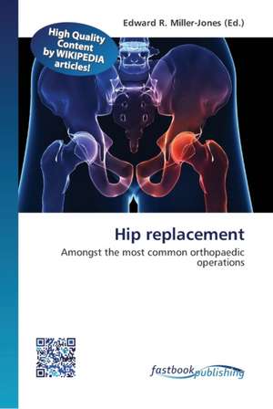 Hip replacement de Edward R Miller-Jones