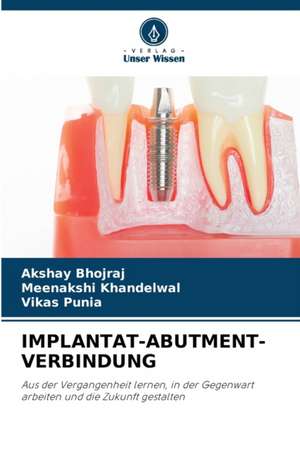 IMPLANTAT-ABUTMENT-VERBINDUNG de Akshay Bhojraj