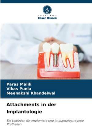 Attachments in der Implantologie de Paras Malik