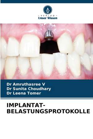 IMPLANTAT-BELASTUNGSPROTOKOLLE de Amruthasree V