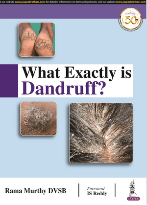 What Exactly is Dandruff? de Rama Murthy DVSB