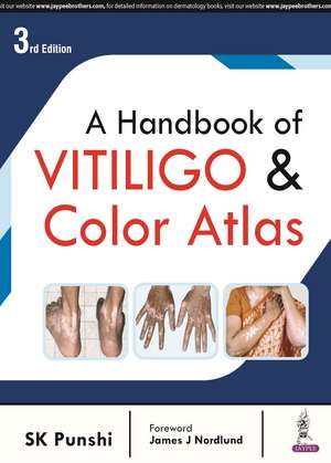 A Handbook of Vitiligo & Color Atlas de SK Punshi