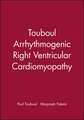 Arrhythmogenic Right Ventricular Cardiomyopathy