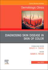 Diagnosing Skin Disease in Skin of Color, An Issue of Dermatologic Clinics