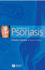 Handbook of Psoriasis 2e