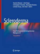 Scleroderma: From Pathogenesis to Comprehensive Management